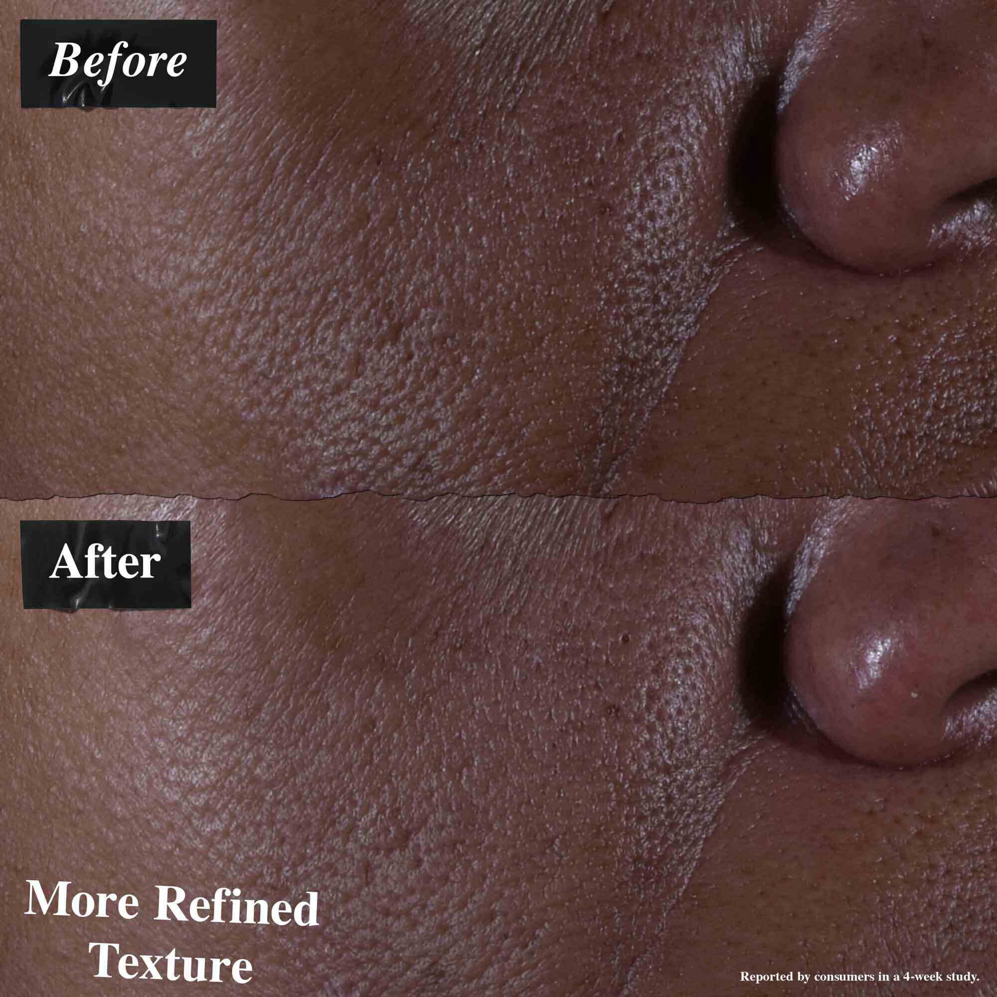 O comparație inainte și după care arată pielea tratată cu Ultra Pure 9.8% Glycolic Acid Serum. Imaginea „inainte” arată o textură neuniformă, in timp ce imaginea „după” arată o textură mai rafinată.