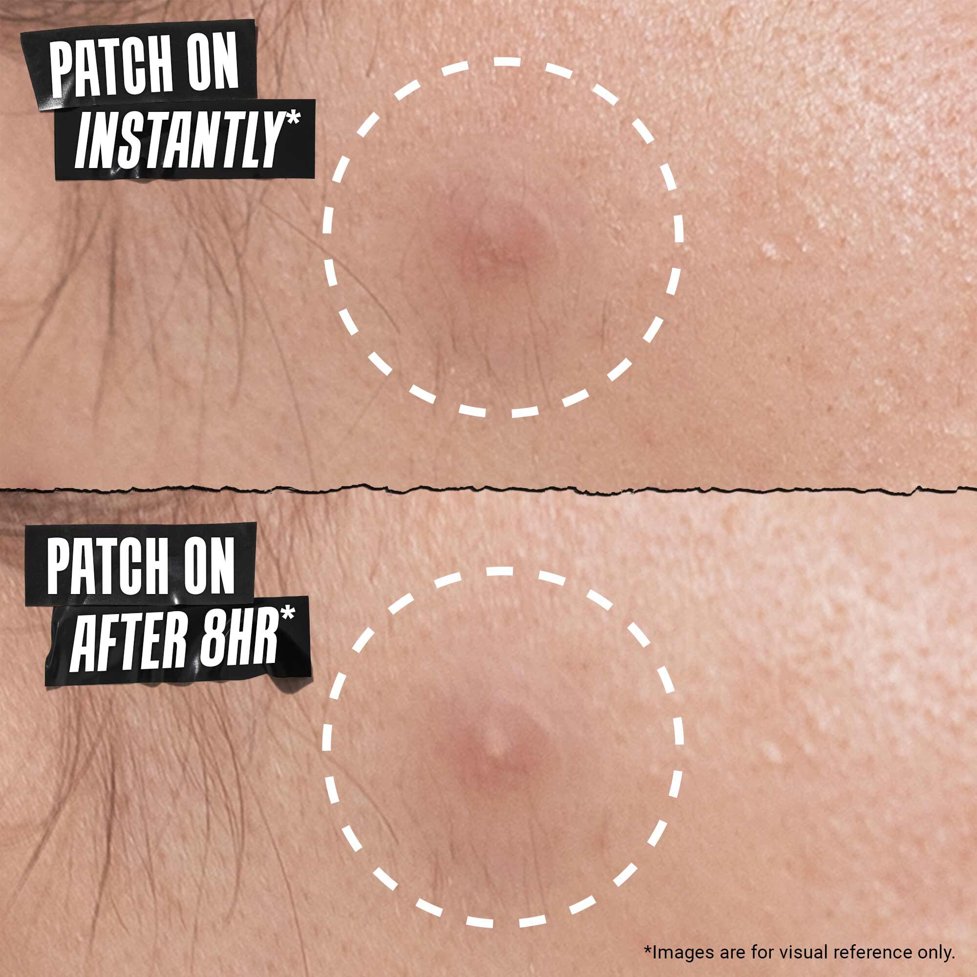 Truly Targeted Overnight Blemish Patch - Plasturi anti-imperfecțiuni