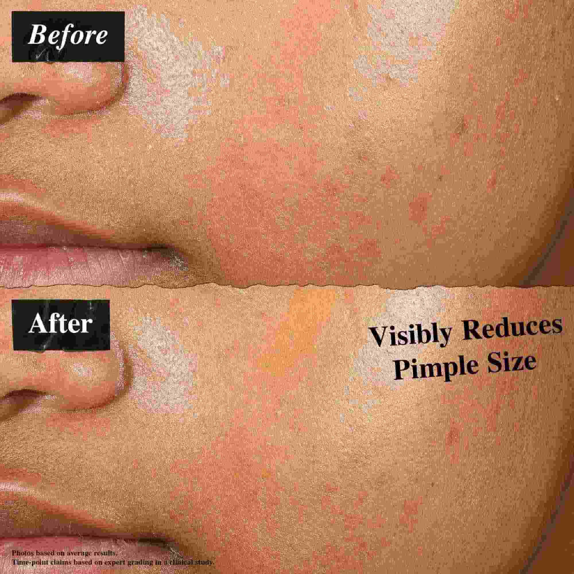 O comparație inainte și după care arată pielea tratată cu Truly-Targeted Blemish-Clearing Solution. Imaginea "inainte" arată coșuri vizibile, in timp ce imaginea "după" arată dimensiunea redusă a coșurilor.