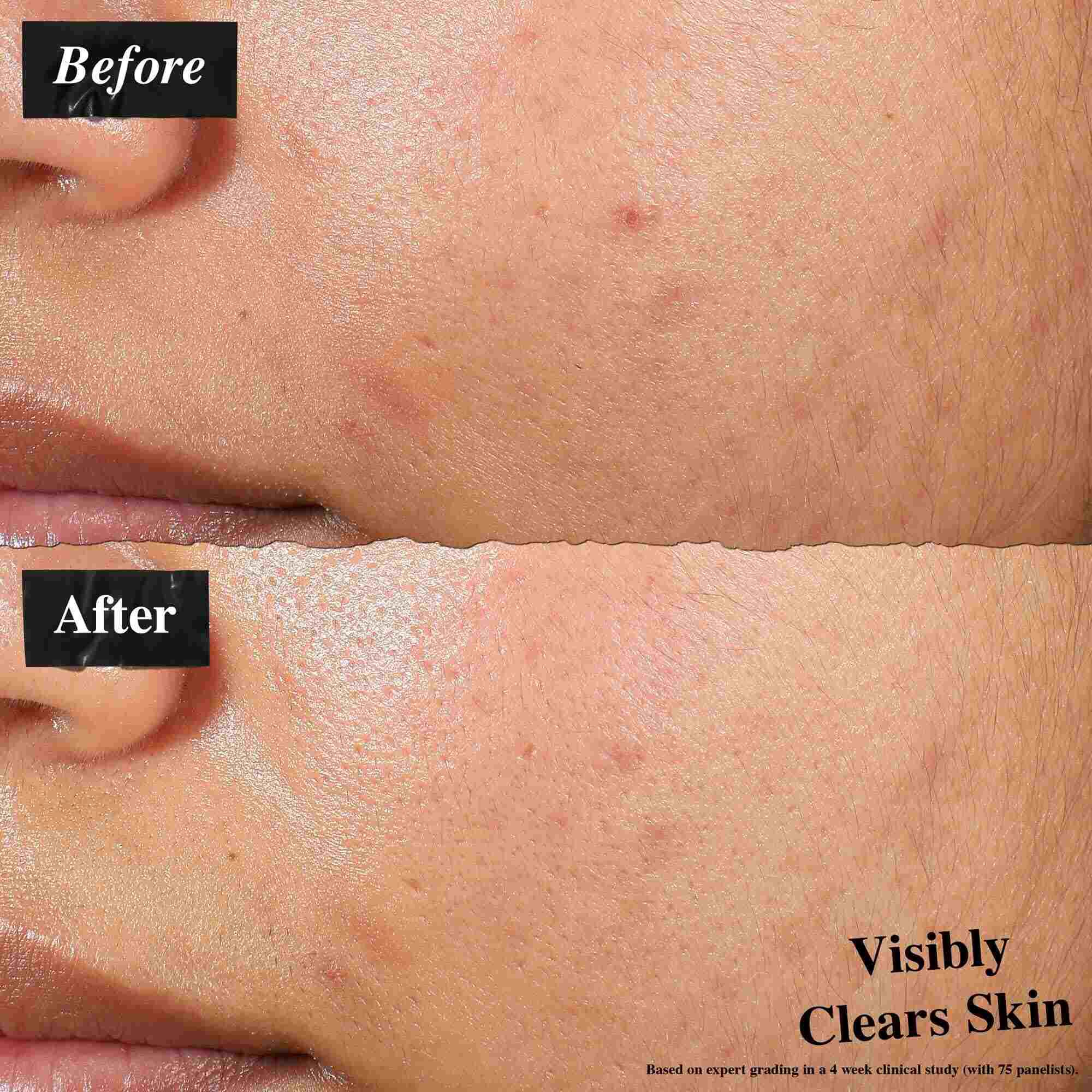 O comparație inainte și după care arată pielea tratată cu Expertly Clear Blemish-Treating & Preventing Lotion. Imaginea „inainte” arată imperfecțiuni și textură neuniformă, in timp ce imaginea „după” arată o piele vizibil mai curată.