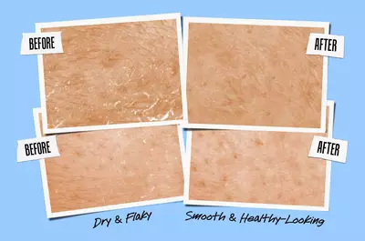 Before and after skin treatment comparison showing two sets of images: the "before" images depict dry and flaky skin, while the "after" images show smooth and healthy-looking skin.