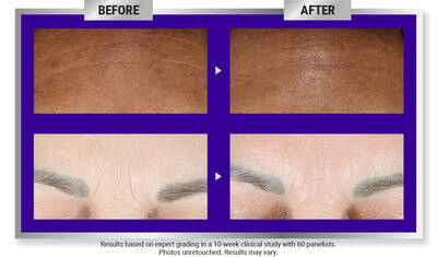 Before and After Retinol Serum