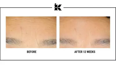 Before and after images showing the forehead area of a person, highlighting differences in skin appearance after 12 weeks of treatment. The "Before" image shows visible lines, while the "After" image displays smoother skin with reduced wrinkles.