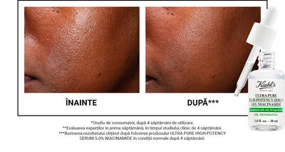 Alt text: A side-by-side comparison of skin before and after 4 weeks of using Kiehl's Ultra Pure High-Potency Serum with Niacinamide. The "before" image shows uneven texture, while the "after" image reveals smoother skin. A dropper bottle of the serum is shown in the corner.