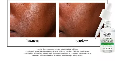 Alt text: A side-by-side comparison of skin before and after 4 weeks of using Kiehl's Ultra Pure High-Potency Serum with Niacinamide. The "before" image shows uneven texture, while the "after" image reveals smoother skin. A dropper bottle of the serum is shown in the corner.