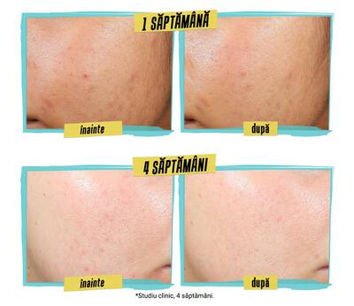 Comparison image showing before and after results of acne treatment. The "before" photos display skin with blemishes, while the "after" photos show clearer skin, highlighting 100% of users experienced acne clearing and a 31% reduction in post-blemish marks.