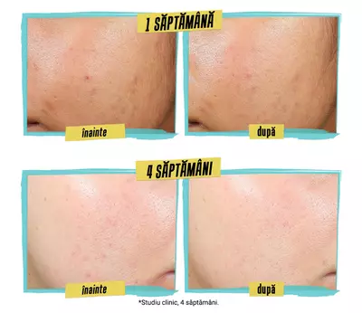 Comparison image showing before and after results of acne treatment. The "before" photos display skin with blemishes, while the "after" photos show clearer skin, highlighting 100% of users experienced acne clearing and a 31% reduction in post-blemish marks.