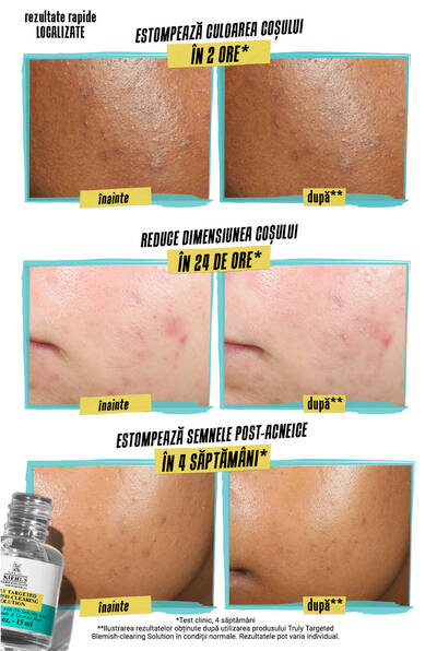 Alt text: A comparison image showing the effects of a skincare product on acne. The top two panels show before and after results of reduced pimple color in 2 hours, with noticeable color improvement. The middle panels depict before and after results of reduced pimple size in 24 hours, showing smaller pimples after treatment. The bottom panels illustrate before